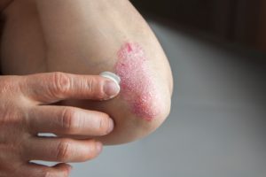 La psoriasis es una enfermedad causada en la piel que causa descamación e inflamación (dolor, hinchazón, calor y decoloración). Para poder quitar psoriasis rápido, tenga en cuenta estas recomendaciones. Quitar psoriasis rápido