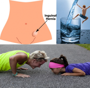 Una hernia inguinal ocurre en la parte del abdomen del cuerpo, antes de que te ocurra, es bueno saber cómo prevenir hernia inguinal, para así no tener que someterse a una cirugía. Como prevenir hernia inguinal