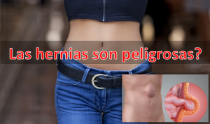 Sabías que, al rededor del mundo, son muchas las cirugías acerca de la hernia. Tanto como hombres y en mujeres, y si no tiene un buen tratamiento las hernias son peligrosas hasta cierto punto Las hernias son peligrosas?